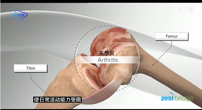 人工膝蓋置換術3D動畫示意圖